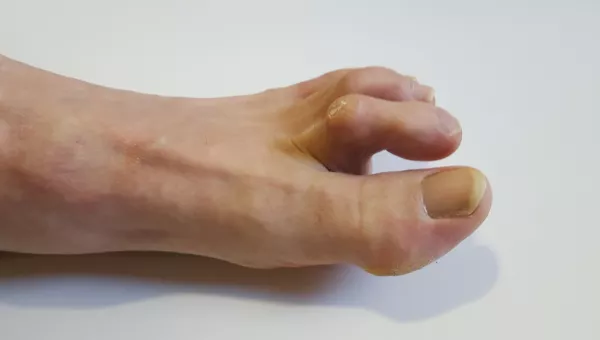 A foot effected with hammer toe