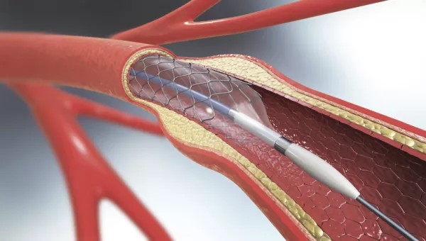 angioplasty image